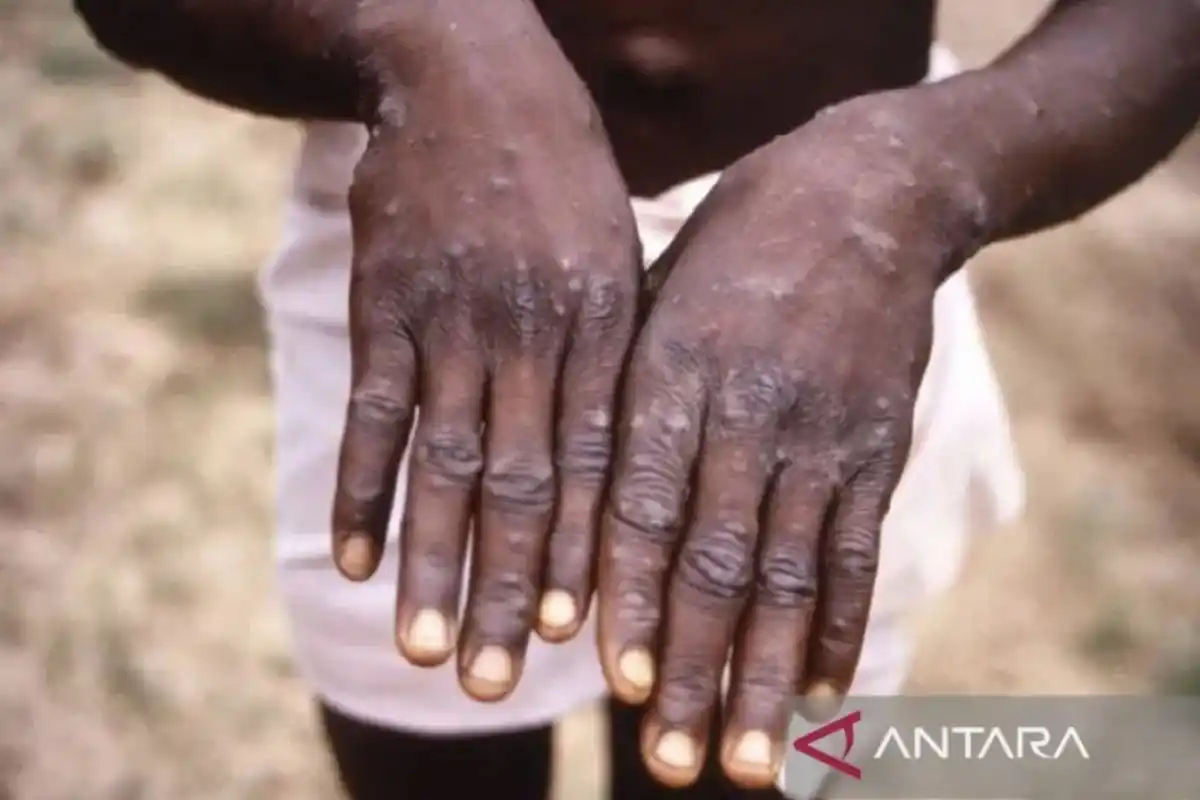 Mpox suspected cases turn negative